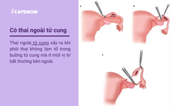 Khái niệm về bệnh có thai ngoài tử cung